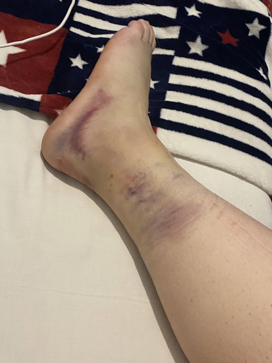 AcnhRubia's tweet photo. Dejo las fotos de mi pie por aqui, para recordarme lo imbécil que soy😪🥺 https://t.co/JMtkNWOO1E