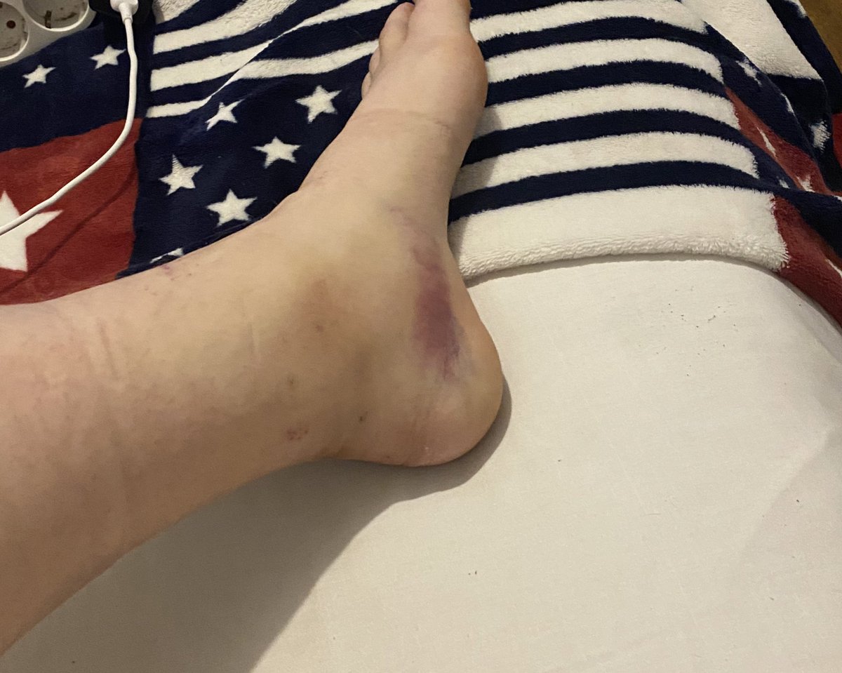 AcnhRubia's tweet photo. Dejo las fotos de mi pie por aqui, para recordarme lo imbécil que soy😪🥺 https://t.co/JMtkNWOO1E