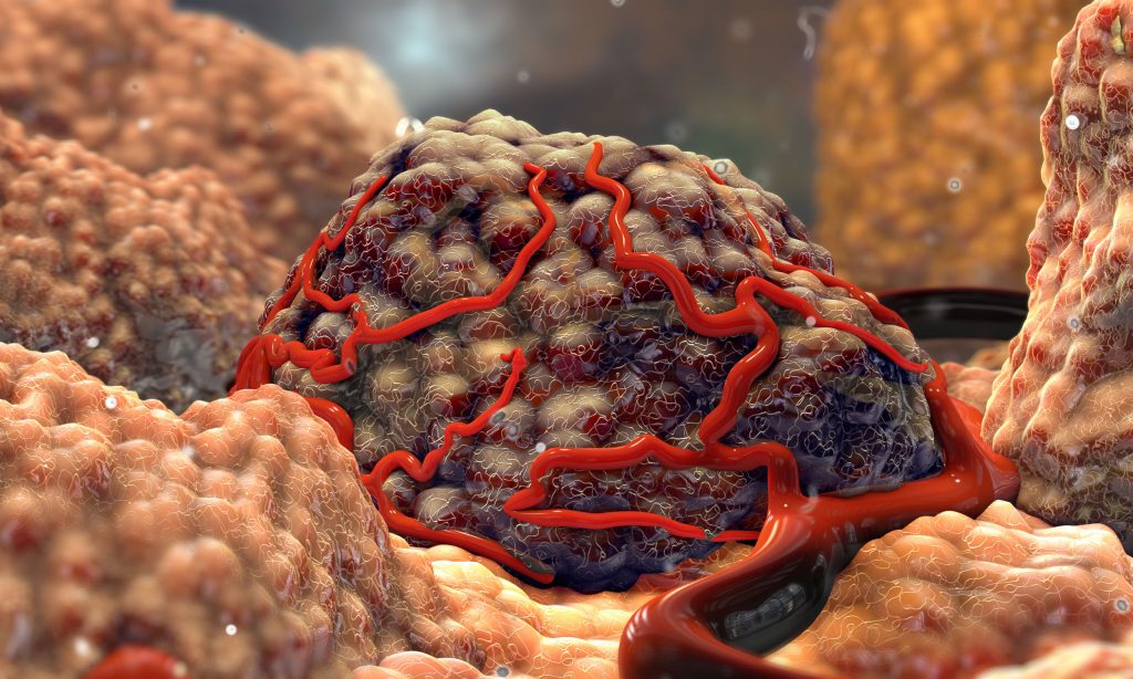 FondazioneBona1's tweet photo. Recurrent breast tumor microenvironment structures, characterized by high #cellular diversity and proliferating cells, are associated with clinical outcomes and genomic profiles indicative of immune escape.
https://t.co/GKzSJuRW1i
#fondazionebonadonna #fondazionemichelangelo https://t.co/E1aZOUSWMv