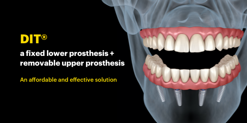 DINP_UK's tweet photo. DIT — a fixed lower prosthesis + a removable upper prosthesis – is a surgical procedure that helps you regain oral health. An economic and effective solution.
.
. 
.
.
.
#dinpuk #dentalimplants #oralhealth #dentist #FixedProsthesis https://t.co/2PQ14HbCgh