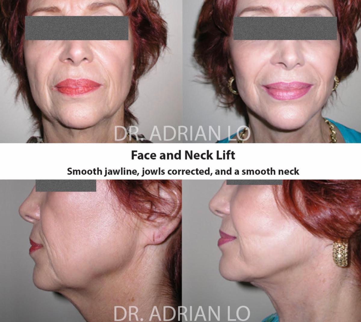 DrAdrianLo's tweet photo. 🏥  Procedure: Outpatient, home the same day
💉 Anesthesia: General, twilight or local
⏰ Length of Procedure: 3 hrs
🚶 Activity: Driving within 3-5 days
🏋 Exercise: Light exercise 10-14 days
✂️ Incision: Temporal hairline down around ear to hairline of neck
☎️: 215.829.6900 https://t.co/ZSbaZbige1