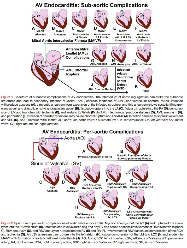 Abdul Jamil Tajik (@ajamiltajik) on Twitter photo & TEE description of subaortic complications ahajournals.org/doi/epdf/10.11…
Look out for Dr Bansal's forthcoming publication in #CASE! cvcasejournal.com/article/S2468-…
<a href="/bansalmd1/">Ramesh Bansal, MD</a> <a href="/purviparwani/">Dr. Purvi Parwani</a> <a href="/VLSorrellImages/">V.L.Sorrell, MD (@CASEfromASE EIC)</a> <a href="/pattypellikka/">Dr.Patricia Pellikka</a> <a href="/garvankane/">Garvan Kane</a> <a href="/JaeKOh2/">Jae K. Oh</a> <a href="/KyleWKlarich/">Kyle W. Klarich</a> <a href="/ChamsiPash/">Mohammed Chamsi Pasha, FACC, FASE</a> <a href="/echo_stepbystep/">Vladyslav Kavalerchyk 🇺🇦</a> & TEE description of subaortic complications ahajournals.org/doi/epdf/10.11…
Look out for Dr Bansal's forthcoming publication in #CASE! cvcasejournal.com/article/S2468-…
<a href="/bansalmd1/">Ramesh Bansal, MD</a> <a href="/purviparwani/">Dr. Purvi Parwani</a> <a href="/VLSorrellImages/">V.L.Sorrell, MD (@CASEfromASE EIC)</a> <a href="/pattypellikka/">Dr.Patricia Pellikka</a> <a href="/garvankane/">Garvan Kane</a> <a href="/JaeKOh2/">Jae K. Oh</a> <a href="/KyleWKlarich/">Kyle W. Klarich</a> <a href="/ChamsiPash/">Mohammed Chamsi Pasha, FACC, FASE</a> <a href="/echo_stepbystep/">Vladyslav Kavalerchyk 🇺🇦</a>