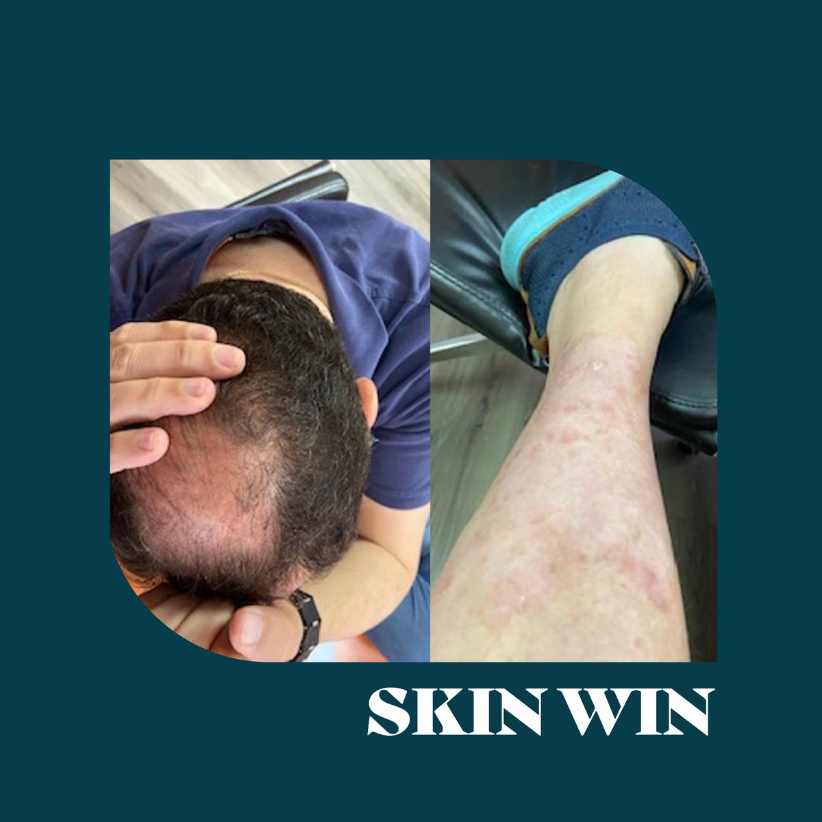 bodewellskin's tweet photo. “I used the psoriasis calming cream and the relief on my wounds was immediate. In fact, the scaling stopped that very day.” Vladimir, Psoriasis
#psoriasis #PsoriasisWarrior #SkinHealth #SkinFlare #SkinTips #MoreGoodSkinDays #FormulatedForMore #GentleAndPowerful #skinwin https://t.co/quHNhXbDbm