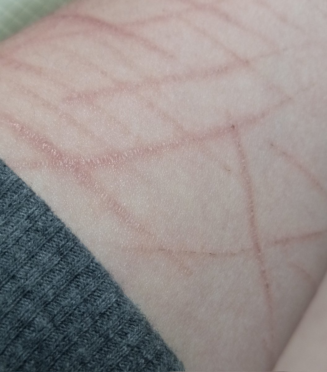 bl00dlusterr's tweet photo. They're healing so well 😻 if they don't look like that when they scar I'm killing myself https://t.co/1VHW4tWoM2