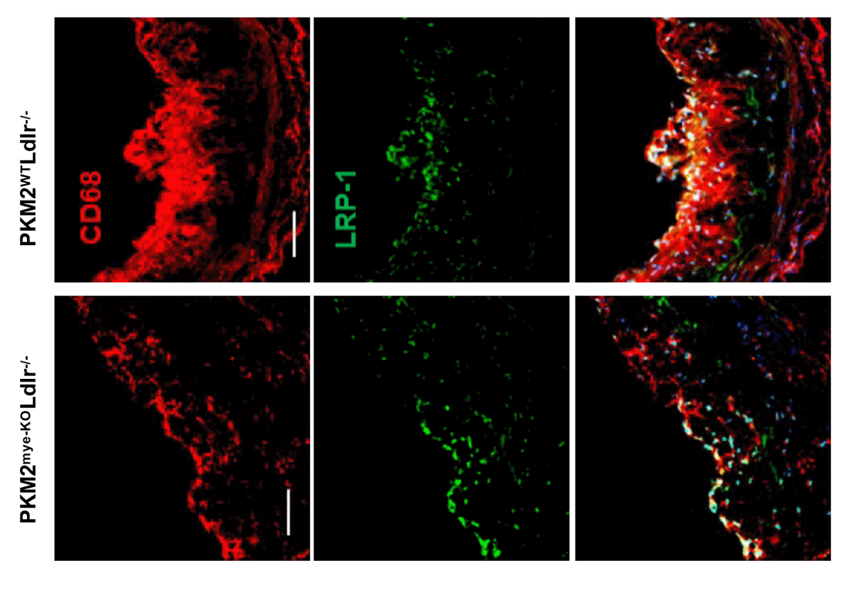 Circulation Research (@circres) on Twitter photo @prakshdp1 et al from <a href="/ChauhanLab/">Chauhan Lab</a> demonstrated that limiting #PKM2 nuclear translocation in myeloid cells enhances #efferocytosis and reduces #atherosclerosis in mice. Learn more at ow.ly/eb8I30si6Xx <a href="/IntMedatIowa/">Internal Medicine at Iowa</a> <a href="/uiowa/">University of Iowa</a> @prakshdp1 et al from <a href="/ChauhanLab/">Chauhan Lab</a> demonstrated that limiting #PKM2 nuclear translocation in myeloid cells enhances #efferocytosis and reduces #atherosclerosis in mice. Learn more at ow.ly/eb8I30si6Xx <a href="/IntMedatIowa/">Internal Medicine at Iowa</a> <a href="/uiowa/">University of Iowa</a>