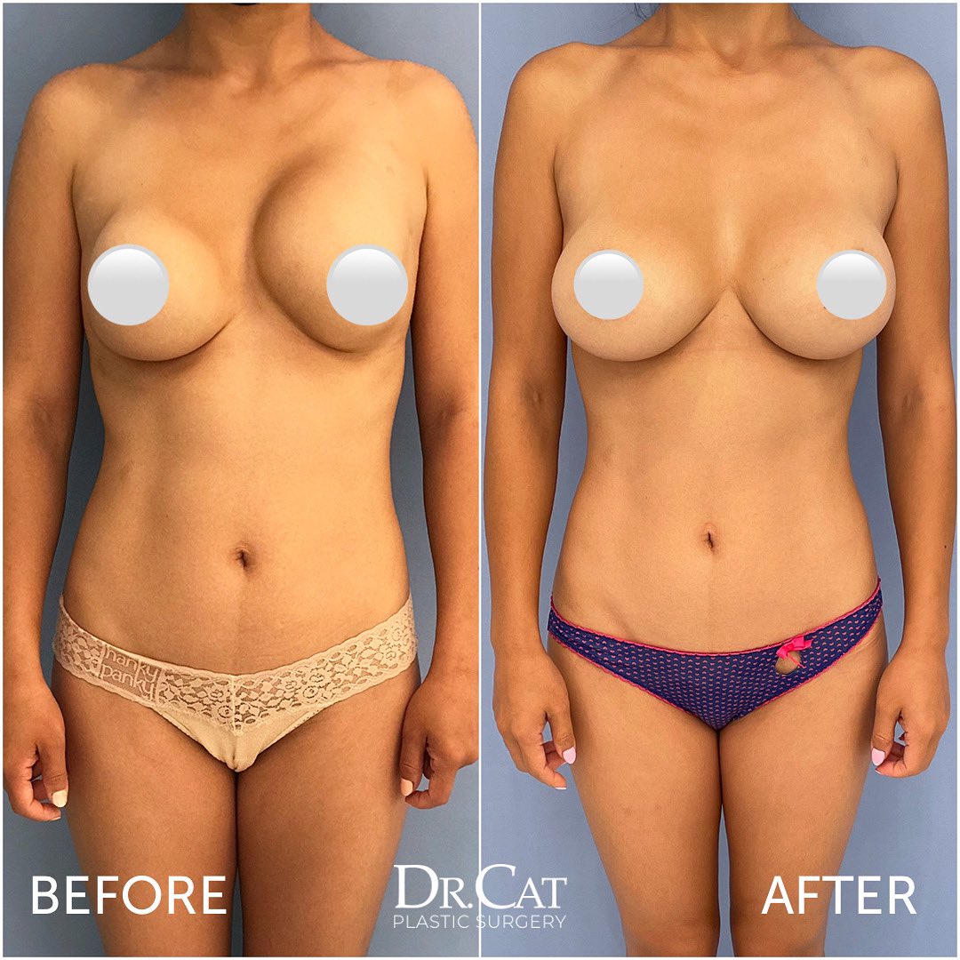 DrCatBegovic's tweet photo. Breast Revision for Severe Stage IV Capsular Contracture #plasticsurgery #breastrevision #capsularcontracture https://t.co/KuBR5AMls8