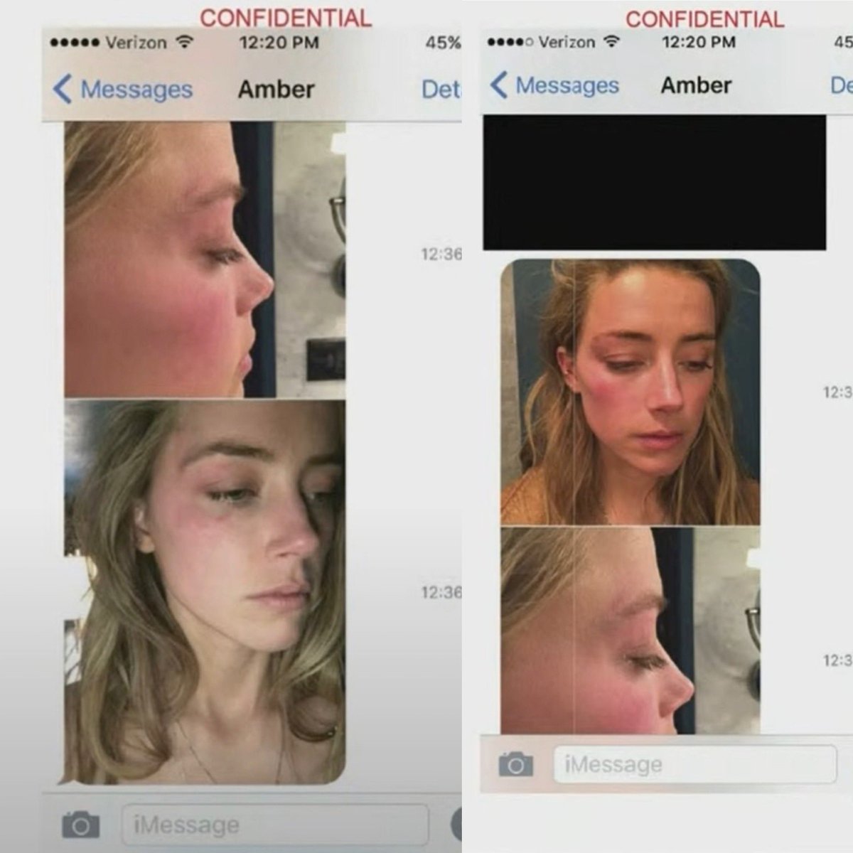 Following the May 21 2016 altercation, Amber texts nurse Erin Boerum that Depp hit her in the face several times and provides photos of her injuries. A medical report confirms the assault. Nurse Boerum would later testify she didn’t believe Amber’s story that Depp was responsible