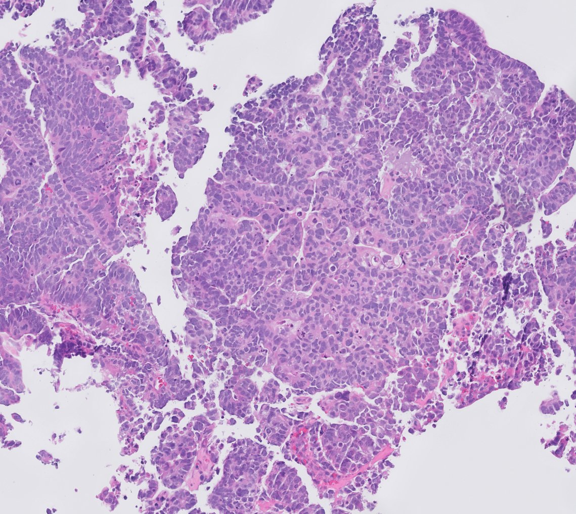 chemily7's tweet photo. 3 mm urinary bladder lesion with surrounding erythema. diagnosis? issues? stains and opportunity to revise impressions tomorrow! #gupath https://t.co/vdzrXvp9l4