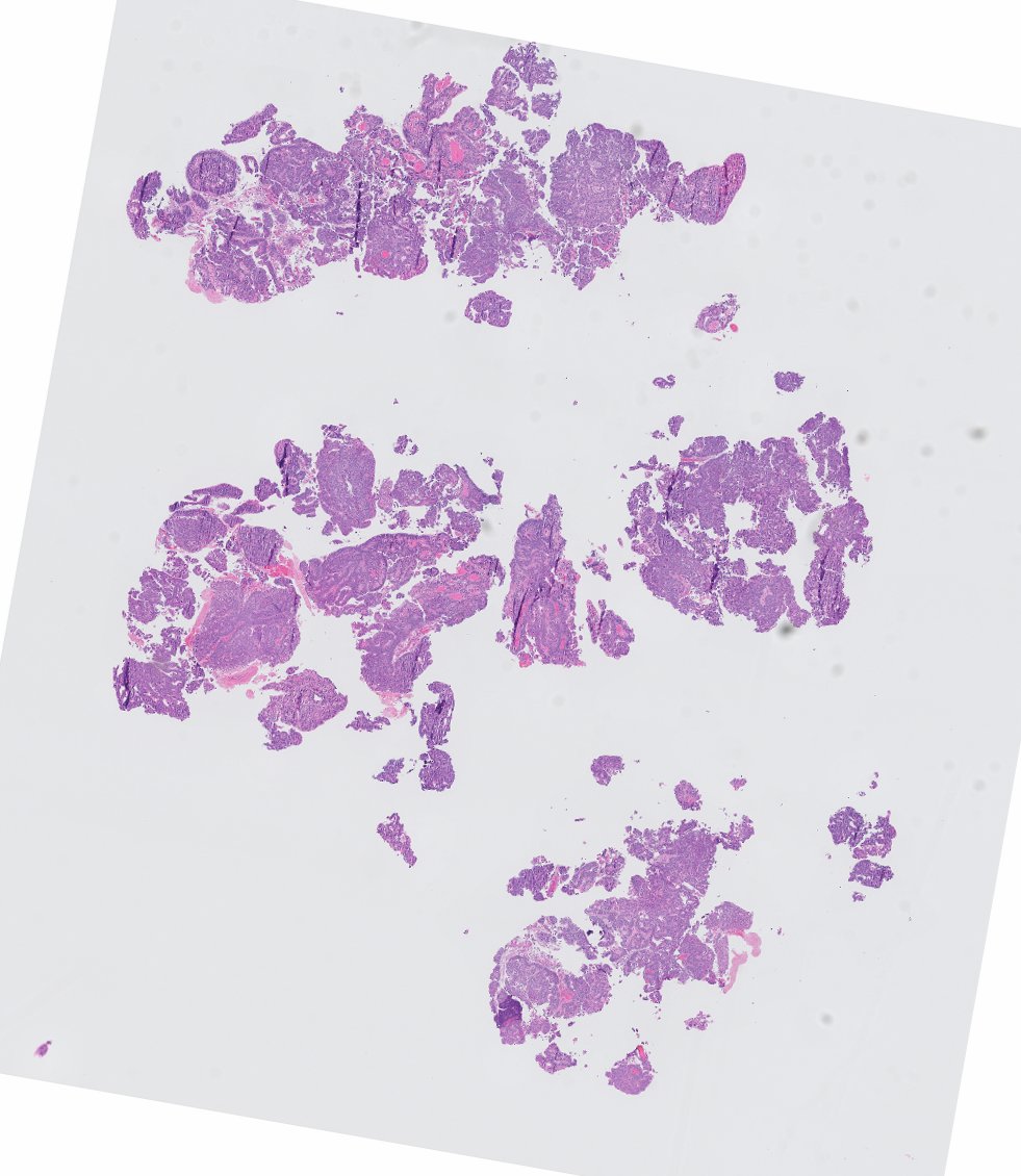 chemily7's tweet photo. 3 mm urinary bladder lesion with surrounding erythema. diagnosis? issues? stains and opportunity to revise impressions tomorrow! #gupath https://t.co/vdzrXvp9l4