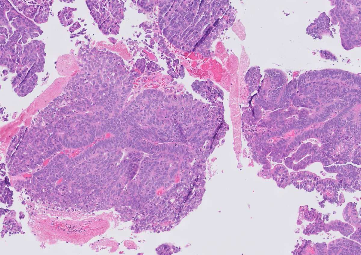 chemily7's tweet photo. 3 mm urinary bladder lesion with surrounding erythema. diagnosis? issues? stains and opportunity to revise impressions tomorrow! #gupath https://t.co/vdzrXvp9l4