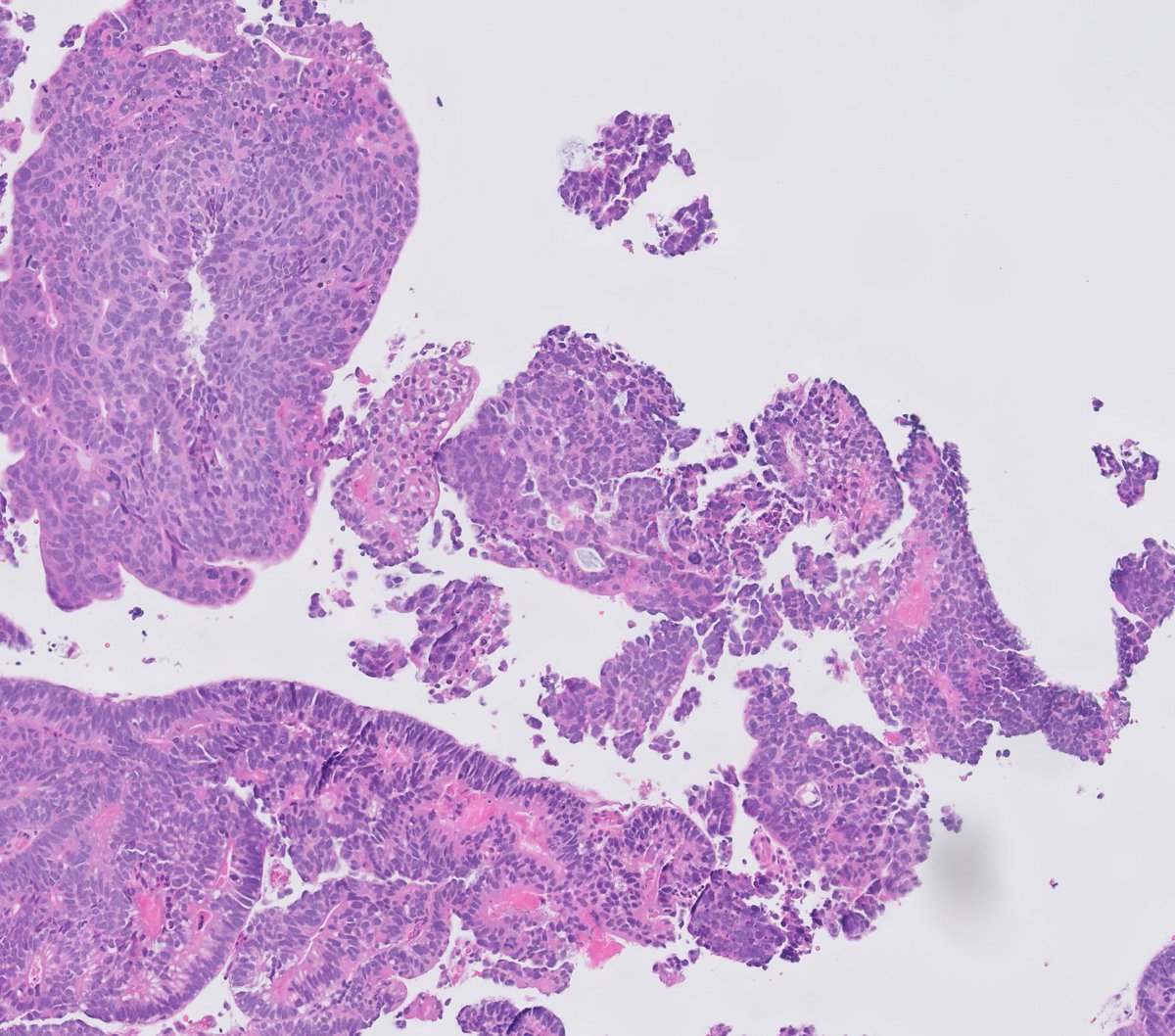 chemily7's tweet photo. 3 mm urinary bladder lesion with surrounding erythema. diagnosis? issues? stains and opportunity to revise impressions tomorrow! #gupath https://t.co/vdzrXvp9l4