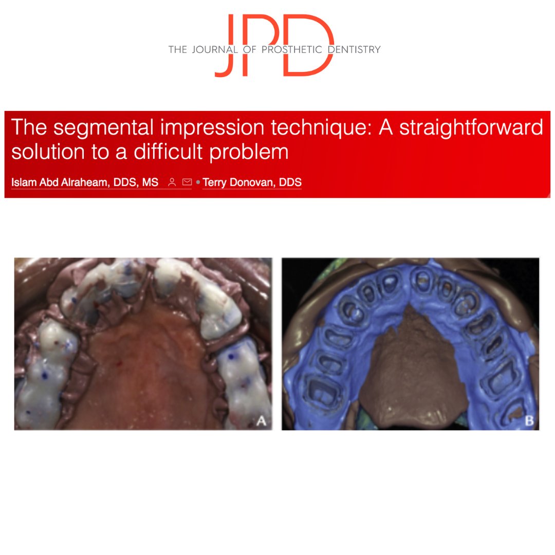 JPDentistry's tweet photo. Making #finalimpressions for a full arch of #naturaltooth preparations is very #techniquesensitive. This #dentaltechnique shows an alternative method that segments the arch to have better control of the #dentalimpression.
Learn more: https://t.co/69ehHBRCCv https://t.co/Bc8aru2PvV