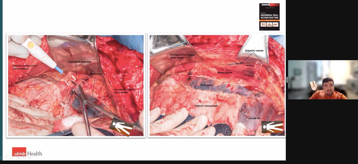 Enlightening talk by my friend @LTastaldiMD via <a href="/ACHQC/">ACHQC</a>, delineating abdominal wall anatomy and clinical applications in #abwallreconstruction. After many blank stares into textbooks, I think I’ll actually remember it this time 💡