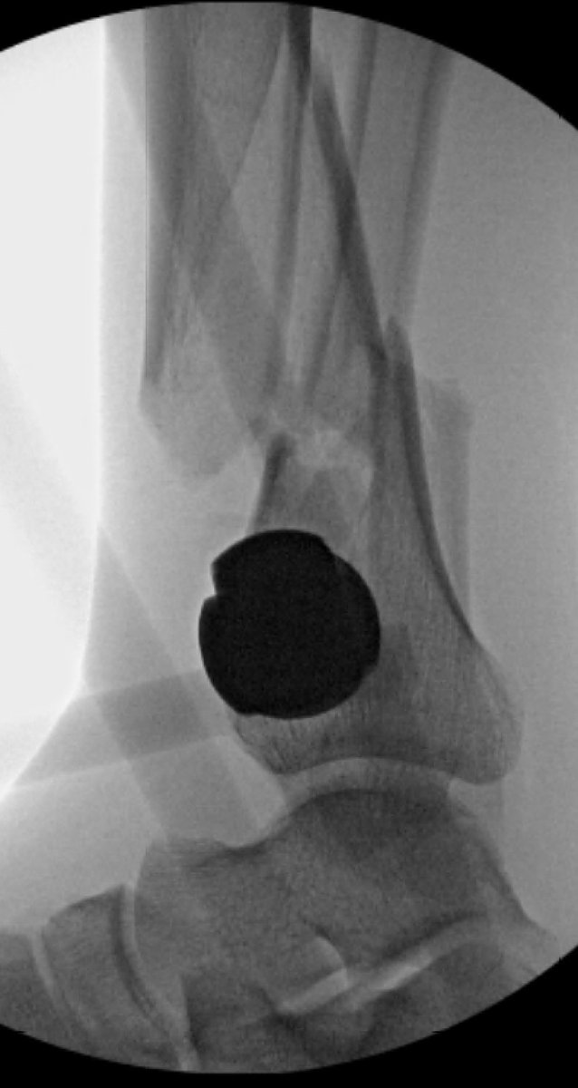 Ex fixes must restore length/alignment/rotation. If you can't get all three ✅'ed off, please send for help immediately, not in 1-2 weeks. A relatively simple thing to correct early becomes significantly harder as time passes.