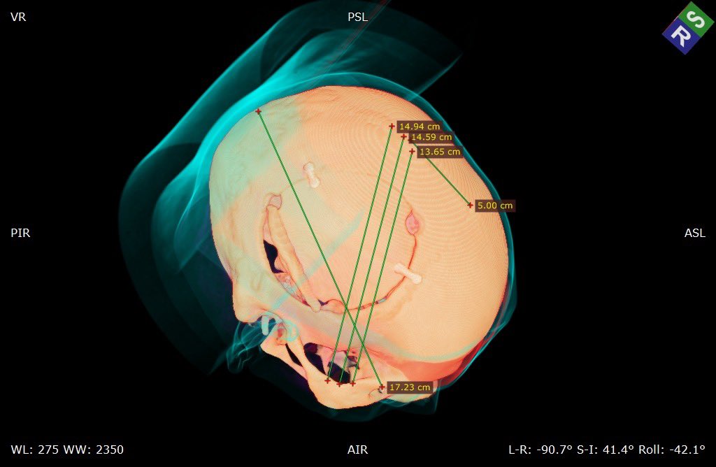 KothiwalaNeal's tweet photo. Planning and execution for recurrent motor strip glioblastoma.
#eloquentcortex #neurooncology #neurosurgery #Glioblastoma #motorstrip #craniotomy #dranilkothiwala https://t.co/yt0z5BuYdP
