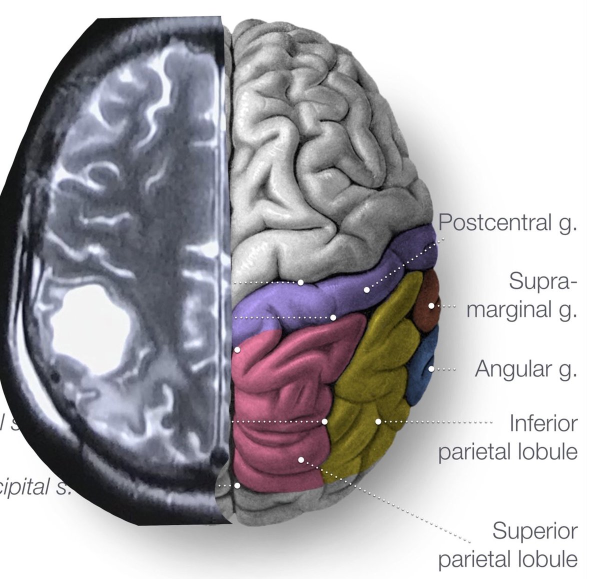 KothiwalaNeal's tweet photo. Planning and execution for recurrent motor strip glioblastoma.
#eloquentcortex #neurooncology #neurosurgery #Glioblastoma #motorstrip #craniotomy #dranilkothiwala https://t.co/yt0z5BuYdP