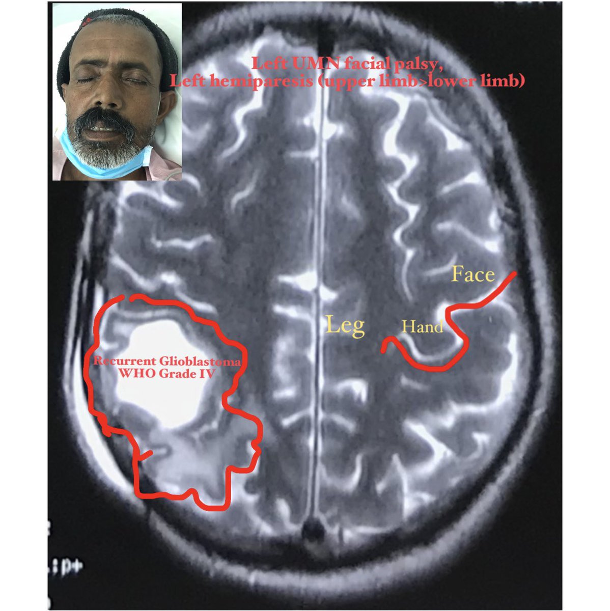 KothiwalaNeal's tweet photo. Planning and execution for recurrent motor strip glioblastoma.
#eloquentcortex #neurooncology #neurosurgery #Glioblastoma #motorstrip #craniotomy #dranilkothiwala https://t.co/yt0z5BuYdP
