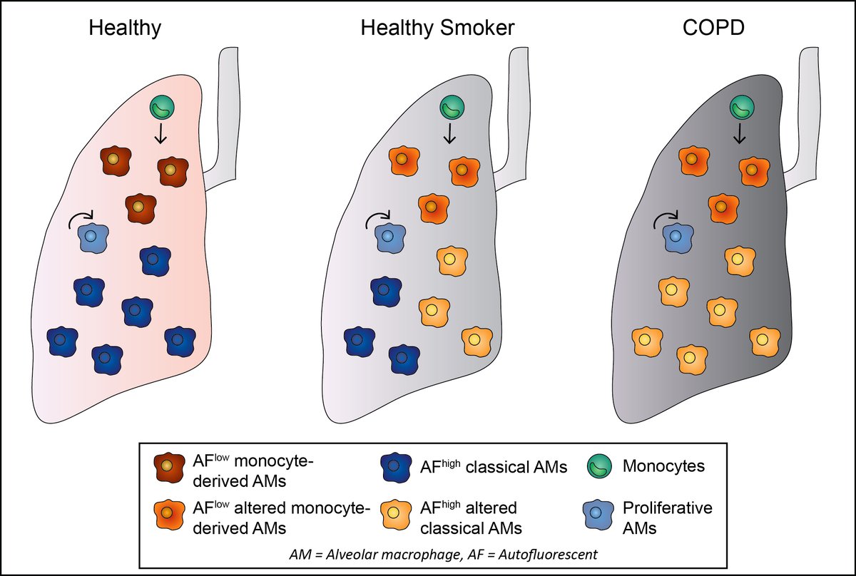 qunich's tweet photo. What happens to the alveolar macrophages in smokers' and COPD patients' lung? Here's my latest publication on AJRCMB:
Increased Pulmonary GM-CSF Causes Alveolar Macrophage Accumulation. Mechanistic Implications for Desquamative Interstitial Pneumonitis
https://t.co/ieddDUd418 https://t.co/9Rhx1T55Kn