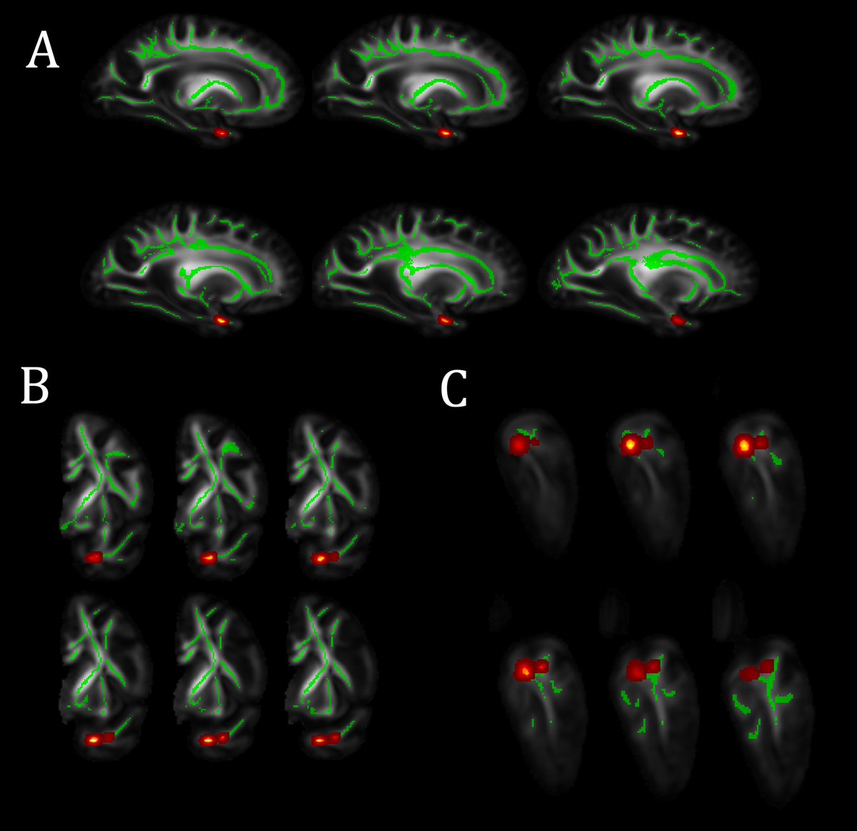 MRIatIIT's tweet photo. Mahir Tazwar will present his work on the association of diffusion anisotropy #FA #DTI with limbic-predominant age-related TDP-43 encephalopathy neuropathological change #LATENC #ISMRM2022 today Tuesday 4:45-6:45 pm BST https://t.co/kE9PUoHxNC Room 3 Abstract #4037. #ISMRM22 https://t.co/JrSAb3skXj