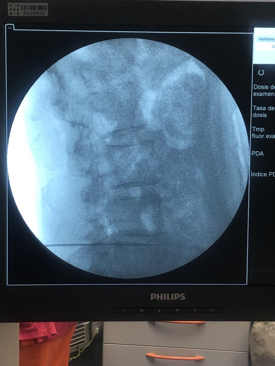 Técnica intradiscal con RESADISC con el Dr. <a href="/HermannRibera/">Hermann Ribera</a> y el Dr. <a href="/MendiolaOsa/">Dr. Mendiola de la Osa</a> en <a href="/SonEspases/">HU Son Espases</a>. Novedosa técnica para combatir el dolor radicular. Nuestro equipo de <a href="/UnidadSon/">Unidad de Dolor HU Son Espases</a> a la vanguardia para los pacientes. Gracias a <a href="/CARDIVAGROUP/">CARDIVA</a>