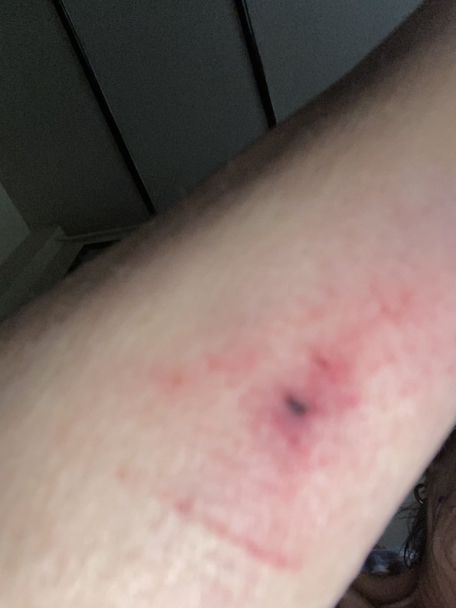 One of my less ‘private’ injuries sustained from being knocked to the ground by a cyclist last night, as I tried to board the K3 from the shared space in this  #antipedestrian  borough which is stopping-up and closing 2km PROW’s