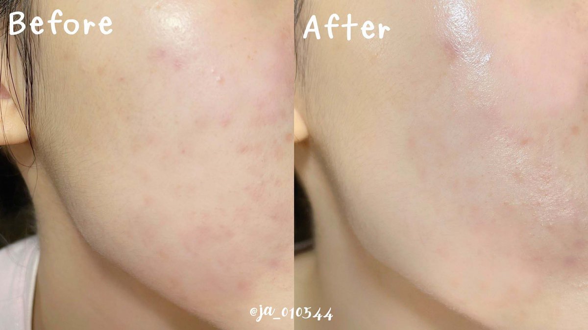 ja_010544's tweet photo. #Skinsista ออกใหม่มาอีกแล้วว Radiance Brightening แพ็คเกจดูดีมาก🫣แล้วราคาก็แบบดีย์อะใช้คู่กันวีคเดียวรู้เรื่อง!!ผิวกระจ่างใสขึ้นแบบรู้สึกได้เลย ชุ่มชื้นแบบสุขภาพดีมากๆ เนื้อซึมง่ายทั้งคู่ ผิวแพ้ง่ายใช้ได้ แบรนด์นี้ใช้ดีทุกตัวไม่ผิดหวังจริงๆ🫠#SSHonestReview #ของดีบอกต่อ https://t.co/H6D7e2y1cV