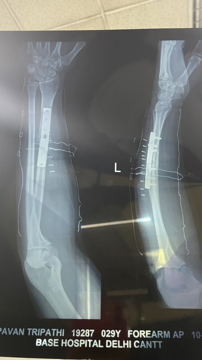 createwithabhi's tweet photo. Surgery Done ✅ Will be on ground soon. 

Thank you everyone for your best wishes 🙂🙏🏼❤️
#createwithabhi #surgery #ACCIDENT https://t.co/hJi3x3NIID