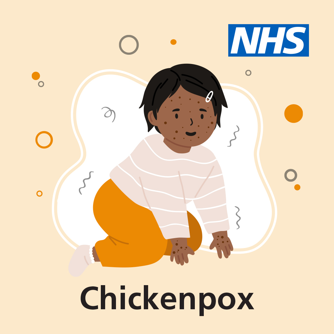 NHS on Twitter: "Although you can catch chickenpox at any age and at