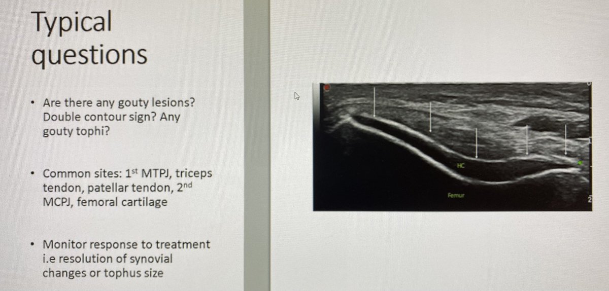 BIR Clinical Imaging Special Interest Group (@bir_ci_sig) on Twitter photo Kicked off today’s Rheumatology Imaging Study Day with a fantastic talk by <a href="/DrQasimAkram/">Dr Qasim Akram (South Manchester Rheumatologist)</a>. Lots of imaging pearls and best practice tips. Available on demand and definitely worth a watch!
<a href="/BIR_News/">BIR</a> <a href="/BIR_YPAT/">BIR YPAT</a> <a href="/DocAliShah/">Ali Shah</a> <a href="/mskradshayan/">Dr Shayan Ahmed</a> Kicked off today’s Rheumatology Imaging Study Day with a fantastic talk by <a href="/DrQasimAkram/">Dr Qasim Akram (South Manchester Rheumatologist)</a>. Lots of imaging pearls and best practice tips. Available on demand and definitely worth a watch!
<a href="/BIR_News/">BIR</a> <a href="/BIR_YPAT/">BIR YPAT</a> <a href="/DocAliShah/">Ali Shah</a> <a href="/mskradshayan/">Dr Shayan Ahmed</a>
