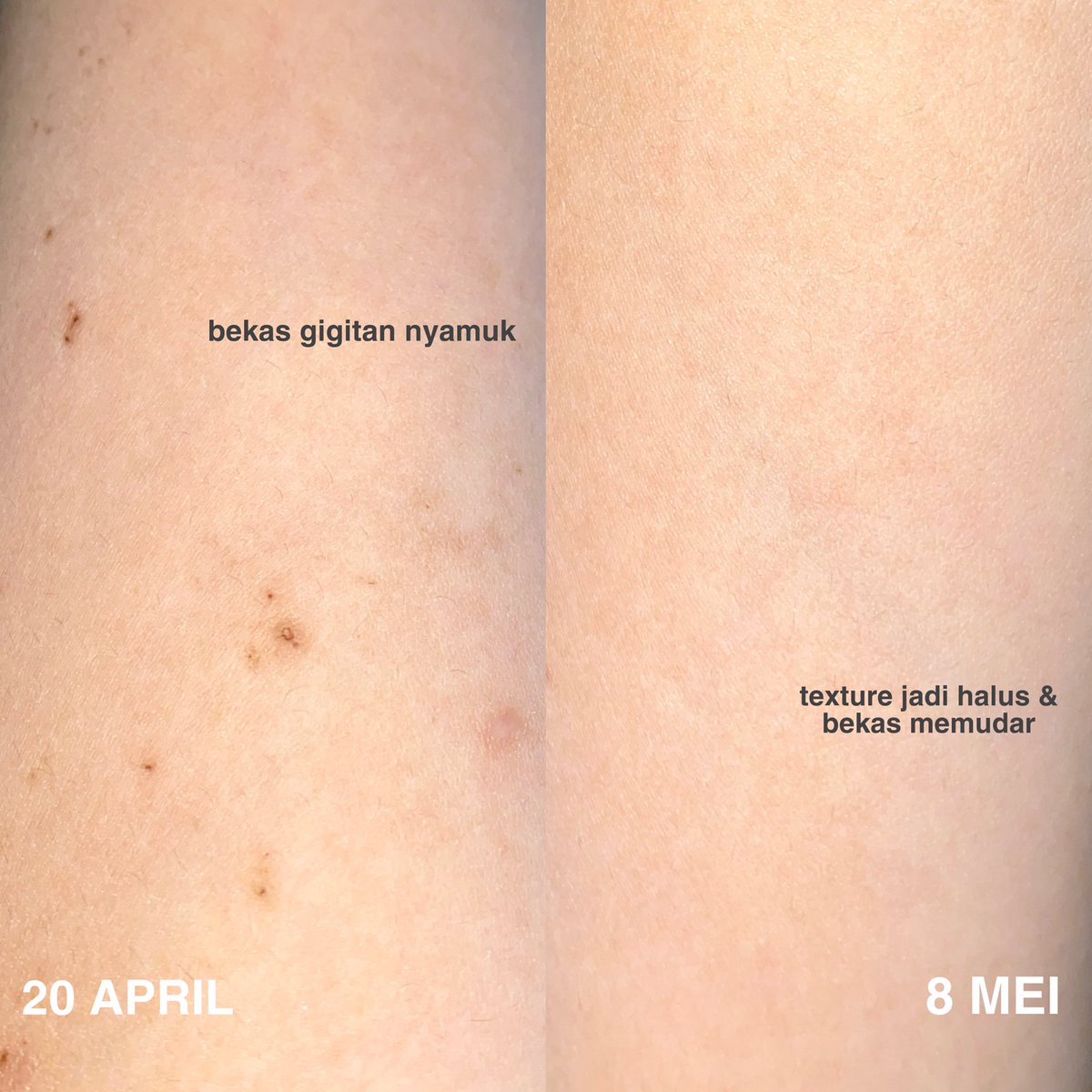 cloudysnowys's tweet photo. ga pede punya bekas luka atau lipatan kulit seperti ketiak, lutut yang bikin kulit jadi gelap?👀

aku mau merekomendasikan salah satu bodycare yang bantu merawat area lipatan atau bekas luka yang bikin kulit jadi gelap✨

produknya ini under 100k!

—a thread

#racuninbodycare https://t.co/U51BTz7MCg