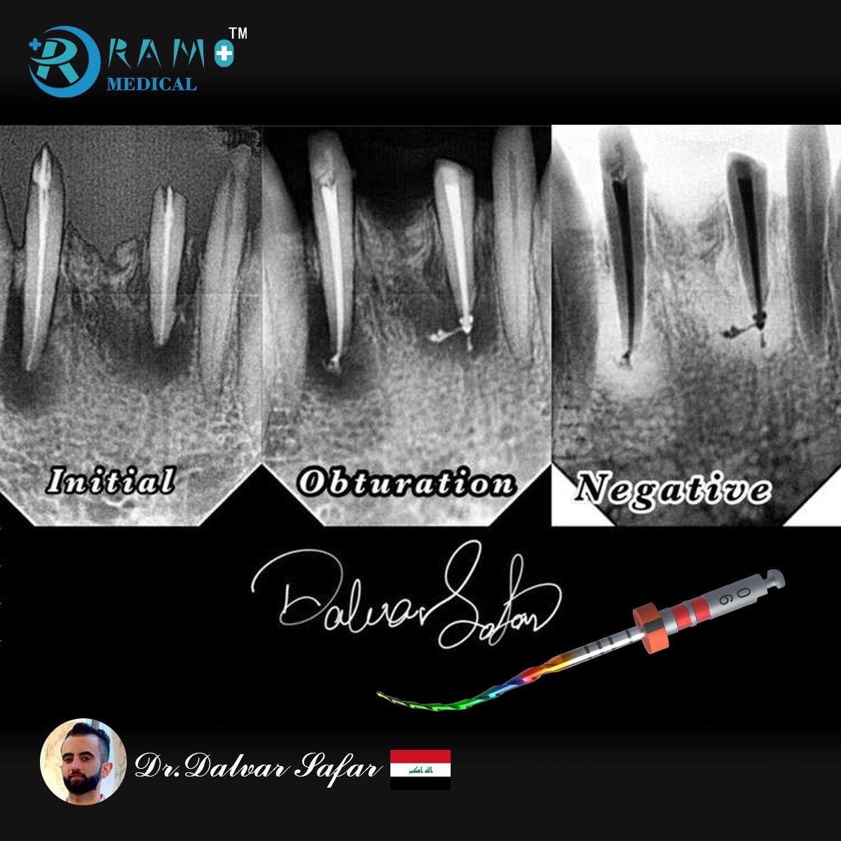 RamoMedical's tweet photo. The latest case sharing is from 𝘿𝙧.𝘿𝙖𝙡𝙫𝙖𝙧 𝙎𝙖𝙛𝙖𝙧 in Iraq. 🇮🇶
 📌Instrument :
𝙍𝘾𝙎 𝙍𝙖𝙞𝙣𝙗𝙤𝙬 𝙊𝙣𝙚 𝙁𝙞𝙡𝙚 #30/04 🌈
#RamoMedical #EndoFile #Endodontic #Endodontia #Dentist #RotaryFile #Dentistry #RainbowOne https://t.co/45u1swsm21