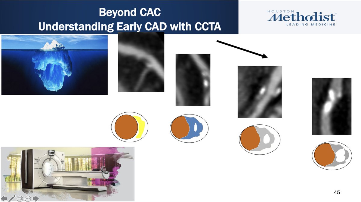 khurramn1's tweet photo. @Umair2017 @purviparwani @mahalrifai @MethodistHosp @WilliamZoghbi @KevinShahMD @SKhanMHCM Beyond CAC, #CCTA will guide insight on atherosclerosis biology
#DrBashiHanif leading the ways for #Pakistan own Framingham Heart Study
#LeadingFromTHeFront #PakSehat
@virani_md @RonBlankstein @miguelcainzos23 @LubbDup @HMethodistMD @rauldsf_santos @GarimaVSharmaMD @OmarChughtai https://t.co/Y3xktUmjIB