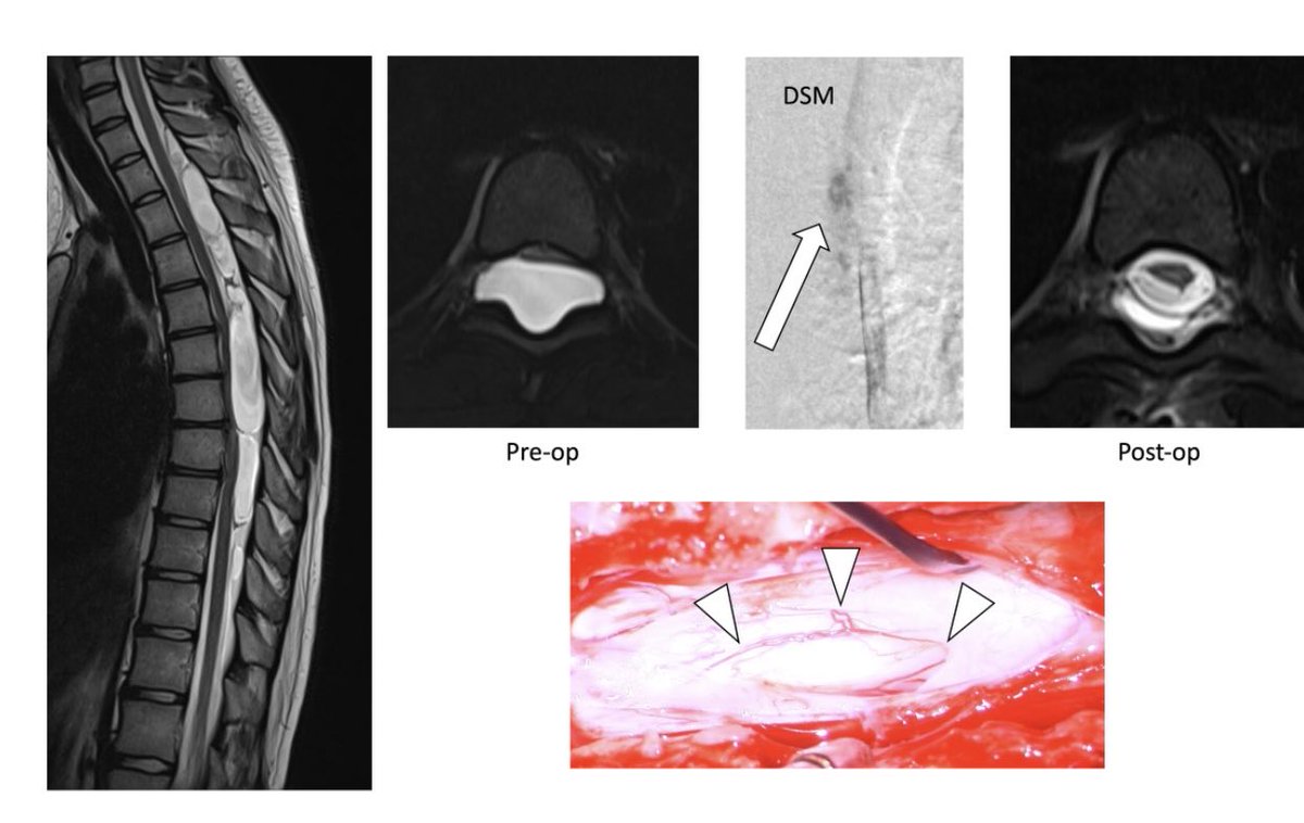 WouterSchievink's tweet photo. Congenital spinal cyst or CSF leak? 16 y-o girl had progressive leg weakness. Complex spinal cyst on MRI. Spinal cord compressed like a thin pancake. At surgery a dorsal dural defect was found and sutured. Cord resumed normal configuration. ⁦@spinalCSFleak⁩ #spinalcyst https://t.co/7nlg2OvPMp
