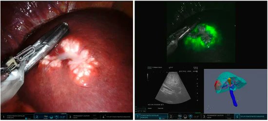 polom_karol's tweet image. Integration of #ThreeDimensional Liver Models in a #Multimodal #ImageGuided Robotic #LiverSurgery Cockpit #imageguidedsurgery #ICG great work by Dutch team @MDPIOpenAccess  mdpi.com/1613004