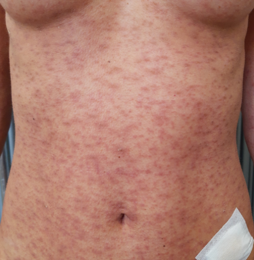 AdverseReports's tweet photo. 31-year-old Caucasian woman presented with an acute generalized rash arising 10 days after the first dose of #Pfizer  BNT162b2 
https://t.co/qAOYuEBxPC https://t.co/OT4Y3WEieg