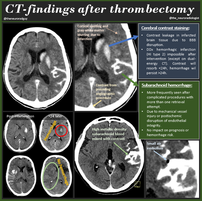 Spectrum of CT-findings after mechanical thrombectomy. Non-exhaustive overview. More info on my instagram account or check out this interesting review from Stroke: ahajournals.org/doi/10.1161/ST… #FOAMrad #FOAMed #MedEd #RadEd #RadRes #Neurorad #stroke #InterventionalRadiology