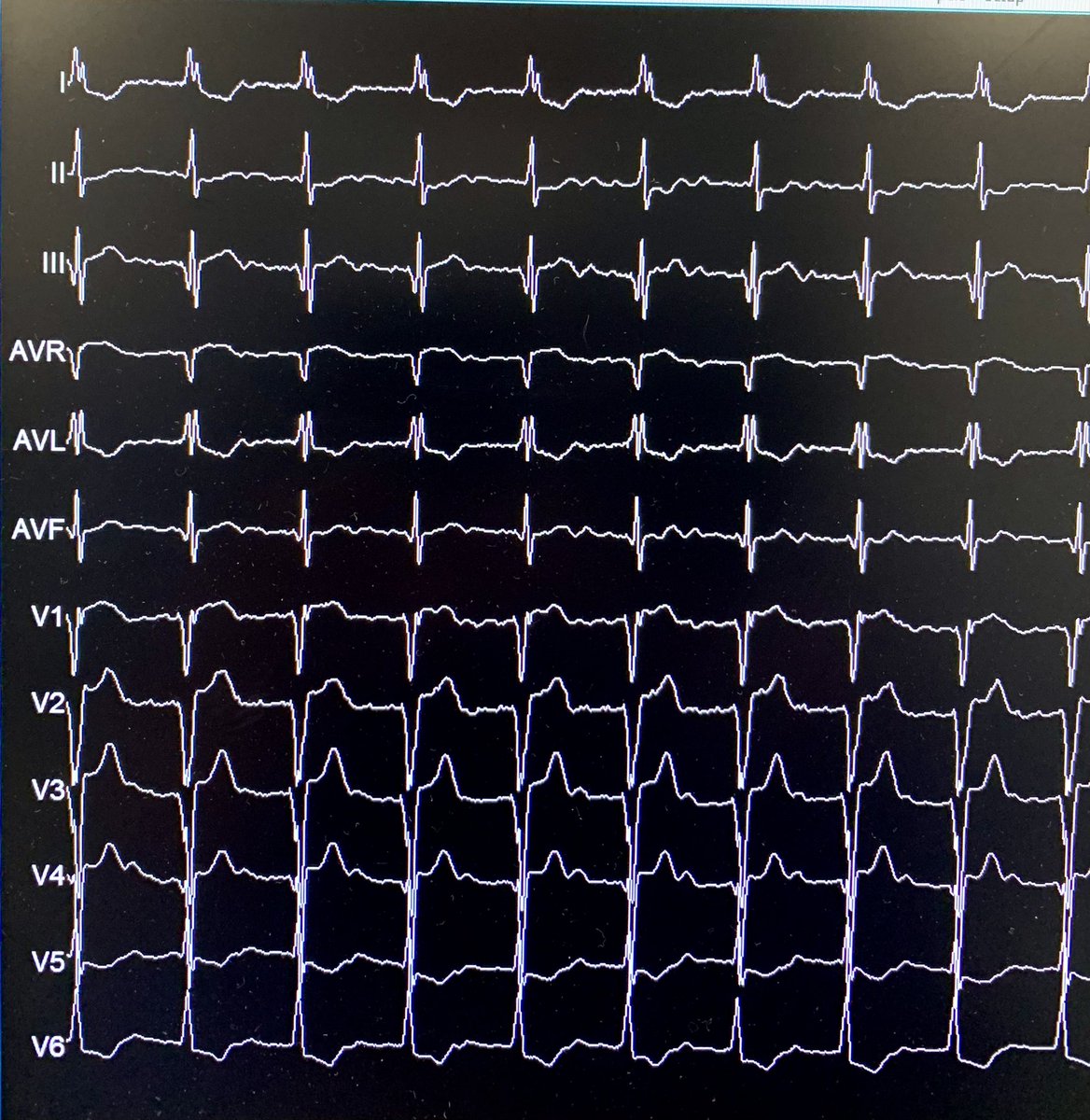 IsaParam's tweet photo. #EEF y solución: Flutter auricular con #BAVC. Estimulación fisiológica (RI) https://t.co/VfcpTPfkSn