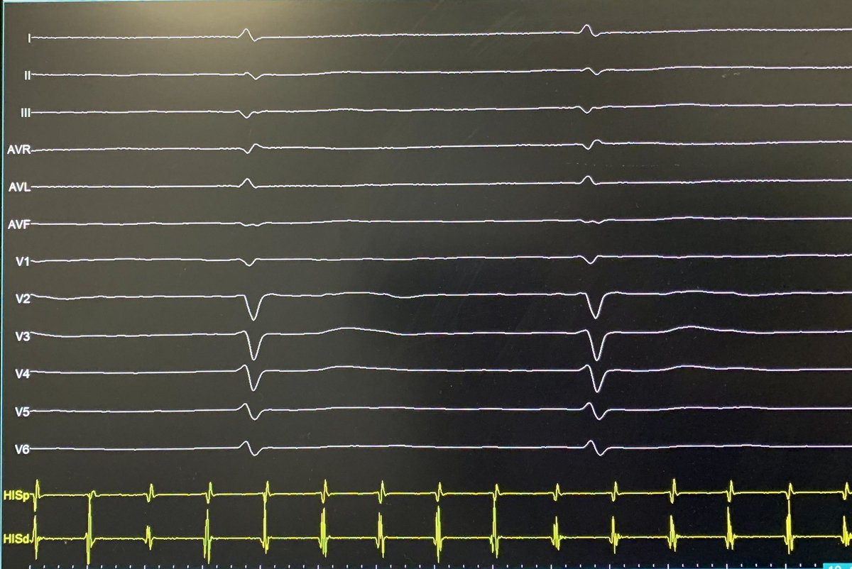IsaParam's tweet photo. #EEF y solución: Flutter auricular con #BAVC. Estimulación fisiológica (RI) https://t.co/VfcpTPfkSn