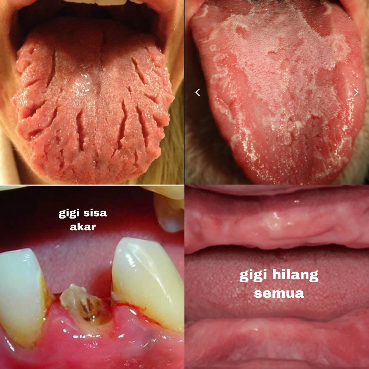 hoamshii's tweet photo. Haii, disini kalau ada yang giginya sisa akar/gigi goyang/gigi mau di cabut bisa dm akuu. Untuk biayanya gratis dan dom jakarta yaa. 
Sama kalau ada yg mau pasang gigi palsu atau ada yang lidah nya bercelah/berbentuk pulau juga bisa dm yaa. Kurang lebih ini gambarannya https://t.co/RDru38XGbN