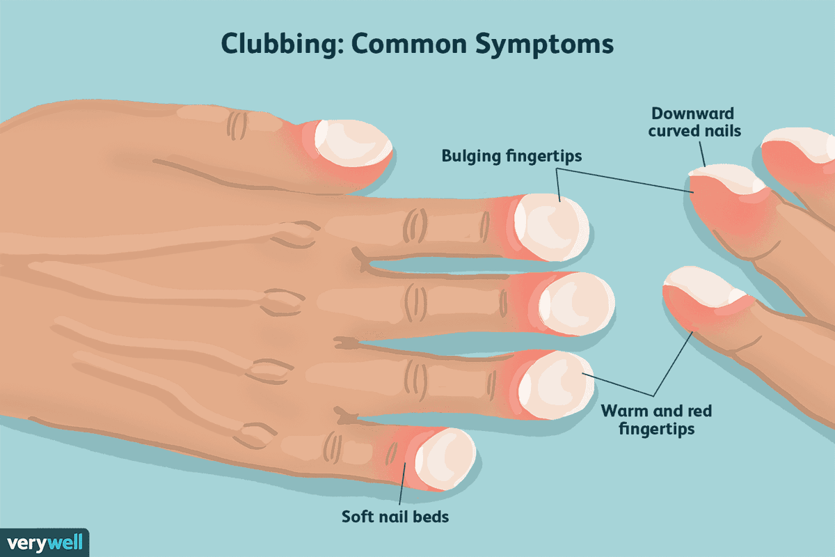 A patient presents with shortness of breath. You're asked to examine their respiratory system.

Looking at their hands you notice something different about their fingernails.

What would you thinking?

#MedEd #Tweetorials
<a href="/MedTweetorials/">MedTweetorials</a>
<a href="/AndreMansoor/">André Martin Mansoor</a> @PeteSullivanPDx