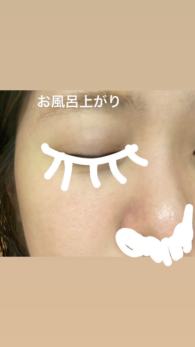 yoruni462's tweet photo. \肌荒れを防いでくれるピールバー赤/
違う洗顔使ったら瞬く間に肌荒れしてしまって、やっぱりコレだ〜！ってなるピールバー

菌の繁殖はアルカリ性に傾いてる時に起きやすくて、ピールバーはお肌を"弱酸性"にしてくれる本当に欠かせない存在

ノーマルカメラでこれ、毛穴の黒ずみなくなるの神すぎる。 https://t.co/cZL8M5wzJS