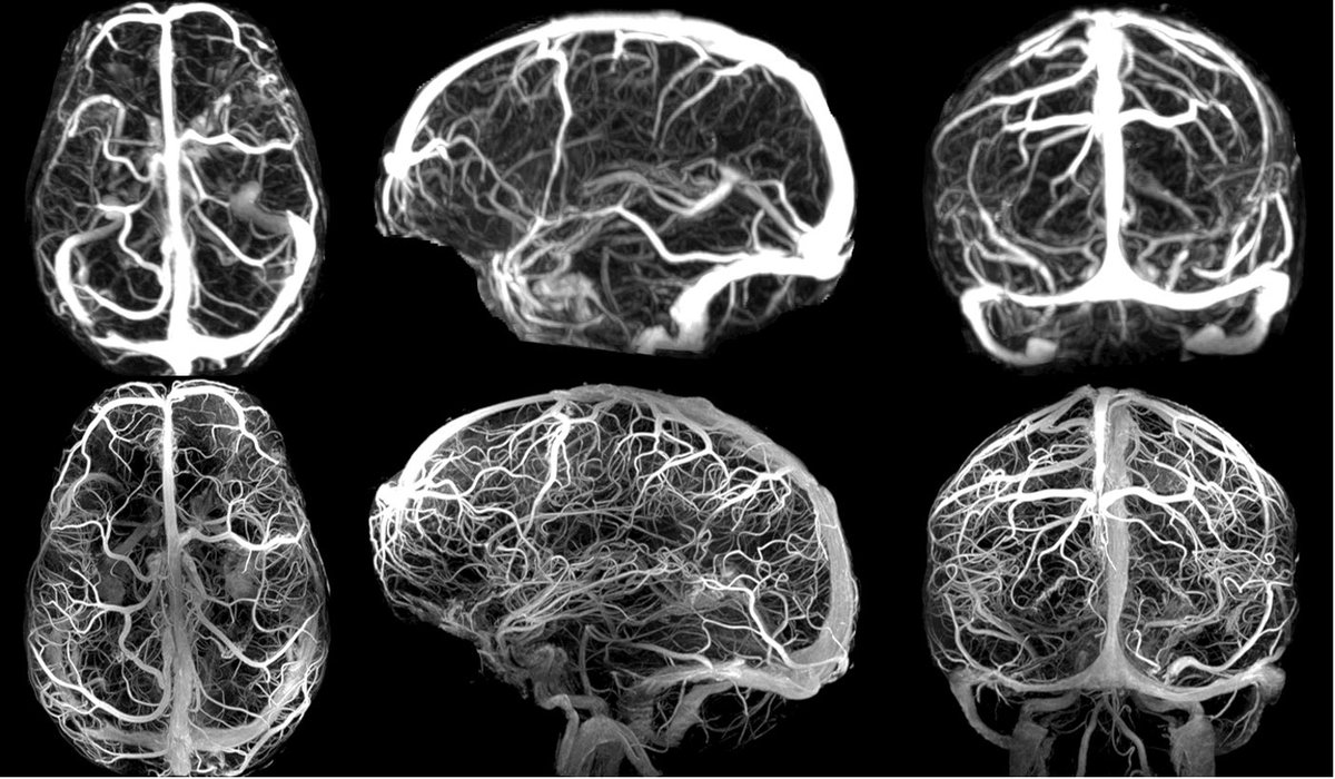 dhairyalakhani's tweet photo. Axial, sagittal, and coronal post-contrast MR angiogram 3D MIP images at 3T and 7T for comparison. https://t.co/uc1PDY6iYz