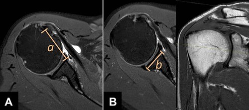 OJSM_SportsMed's tweet photo. The “invisible MGHL sign.” Calculation of the #MGHL medial retraction ratio on preop MRI may give an indication of the severity of the subscapularis tear.
#Subscap
https://t.co/JNJC6Pg3nX https://t.co/3QnsaB79zB
