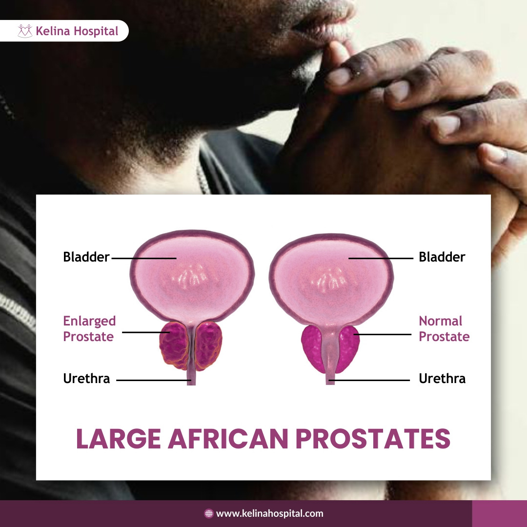 KelinaHospital's tweet photo. Documented research has indicated that Blacks are more likely to develop Benign Prostatic Hyperplasia (BPH) at a younger age than people from other races. They are also more likely to develop prostate cancer at a younger age. The mean age of patients going for prostate surgery https://t.co/JX2RkUOHUZ