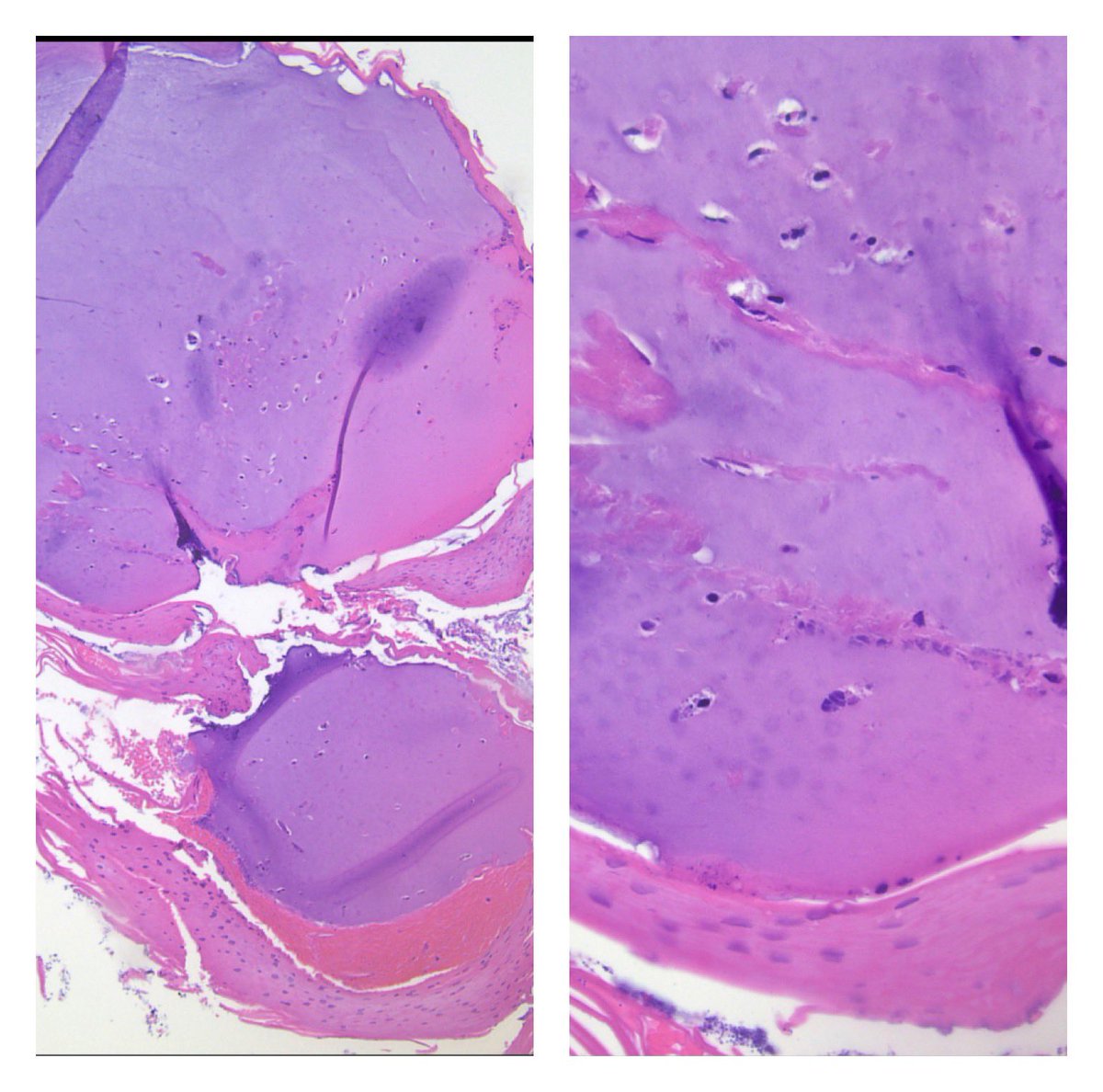 rhpath65's tweet photo. Finger nail lesion. Digital mucinous cyst. No it’s not cartilage ! 
 #medtwitter #PathTwitter #pathology #Path #path2path #pathoutpic #dermpath #softtissue https://t.co/jbC2OpRWTt