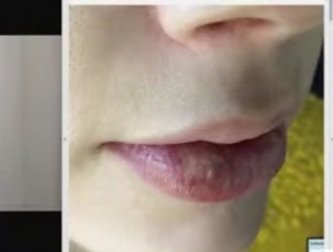NavyMom1776's tweet photo. NOT ABUSE, Not a fat lip! IT'S  A COLD SORE OR SORE. This is what happens when you CONSTANTLY PICK AT YOUR LIP. It's her nervous habit. She bruises her own lip regularly! #AmberHeard #deppvsheardtrial
#AmberHeardlsALiar 
#JusticeForJohnnyDeep https://t.co/IrSAcdddGa
