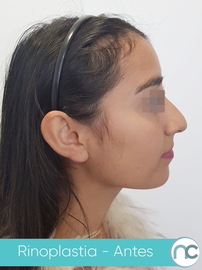 drnelsonchaves's tweet photo. El día de hoy te comparto un antes y después de una cirugía de nariz (rinoplastia).

La nariz es el elemento central de la cara, por tanto, su forma y tamaño pueden complementar la belleza del rostro o, por el contrario, opacarla. https://t.co/NkRsFDwPb9