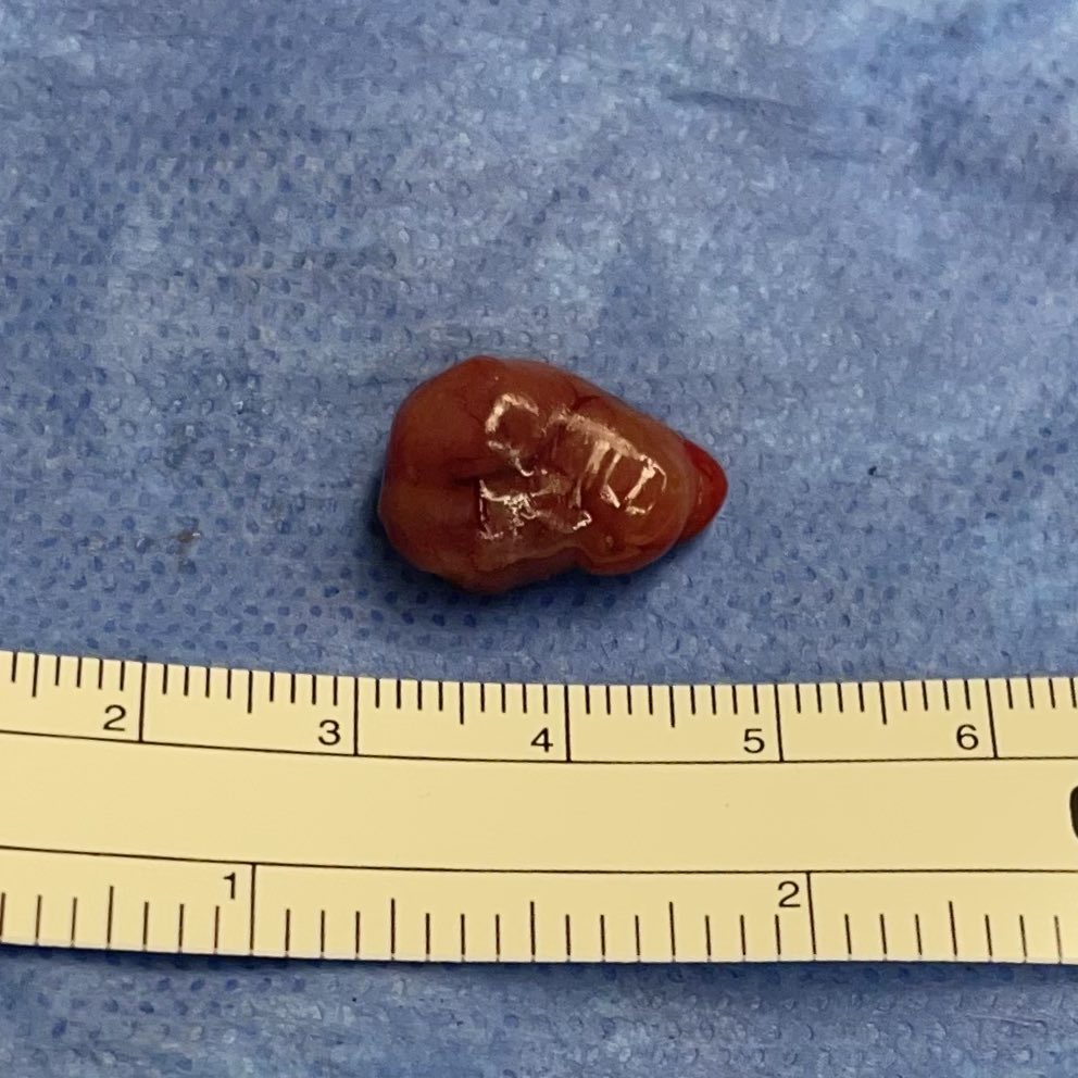 WilliamRBlythe's tweet photo. Parathyroid adenoma on Butterfly in pre-op and on the back table. Focused parathyroidectomy 9 minutes skin-skin.
#ENTwitter #GeneralENT https://t.co/hX2wqkeqA5
