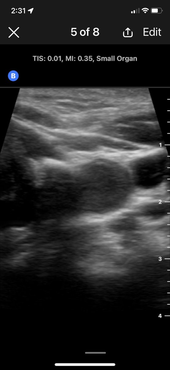 WilliamRBlythe's tweet photo. Parathyroid adenoma on Butterfly in pre-op and on the back table. Focused parathyroidectomy 9 minutes skin-skin.
#ENTwitter #GeneralENT https://t.co/hX2wqkeqA5