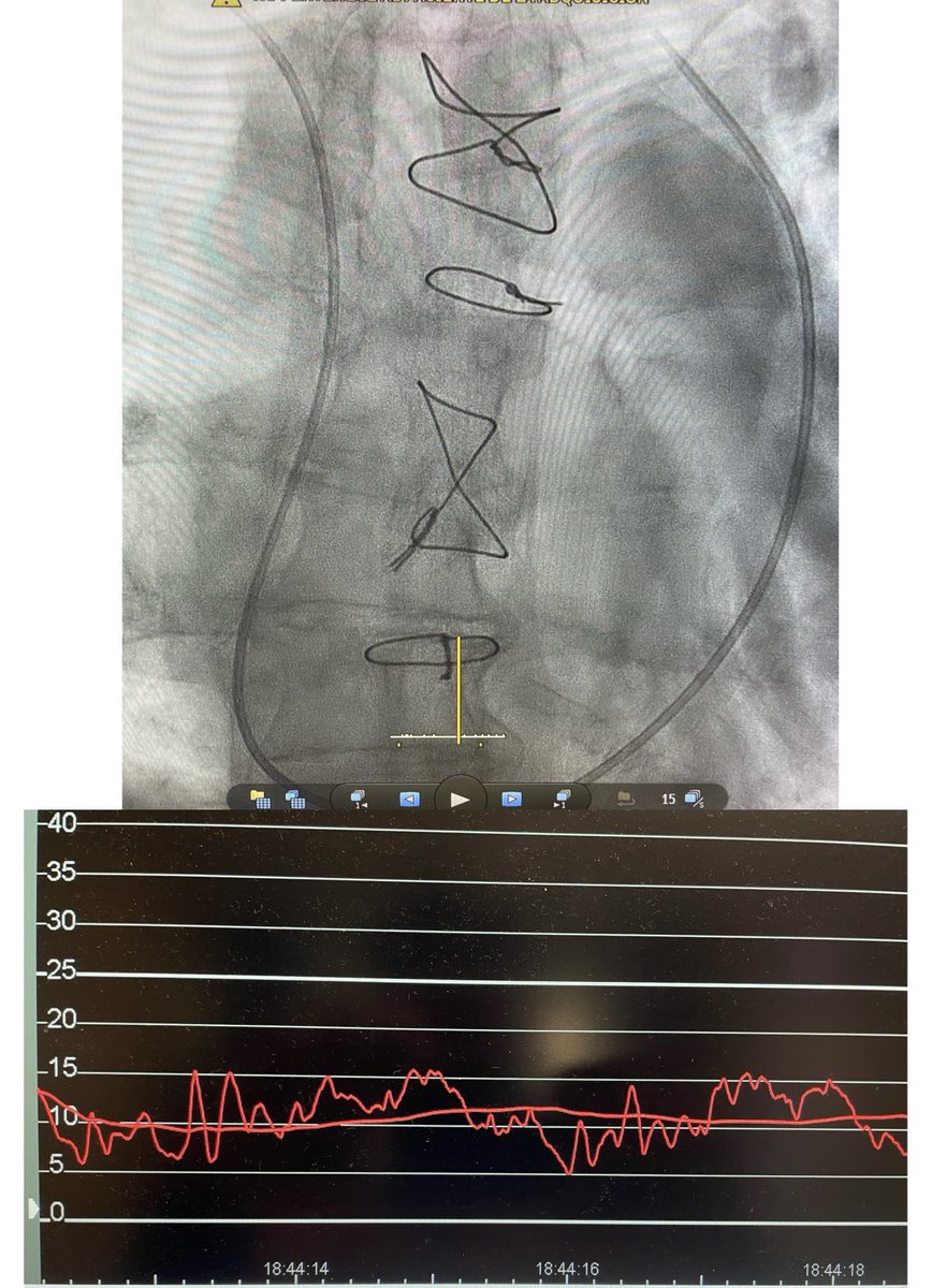 RiSanz2020's tweet photo. 66-yo female with surgically closed sinus venosus ASD. Absence of inferior vena cava. Berman pressure catheter through right basilic vein with that curves at the tip. What is the diagnosis? @MikeHuanca @eriludee #ACHD #CardioTwitter @PCRonline @shci_sec @TCTMD @EuroInterventio https://t.co/y8xvOVEyyu